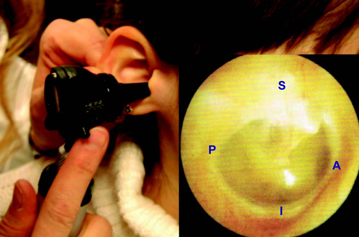 Figura 2. Posición para la otoscopia derecha con la imagen otoscópica normal correspondiente