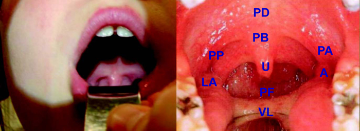 Posición y colocación del depresor por delante de la V lingual para la visualización sin reflejo nauseoso de la orofaringe
