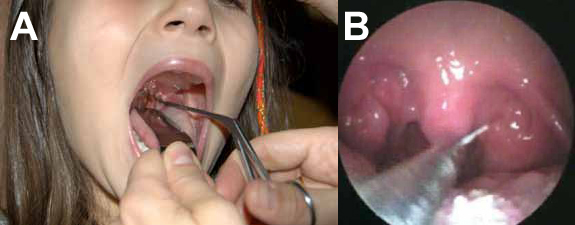 Figura 6. Pasos para la extracción instrumental de un cuerpo extraño orofaríngeo. A: deprimir la lengua con mano izquierda y portar la pinza con la derecha. B: extracción de espina en amígdala izquierda